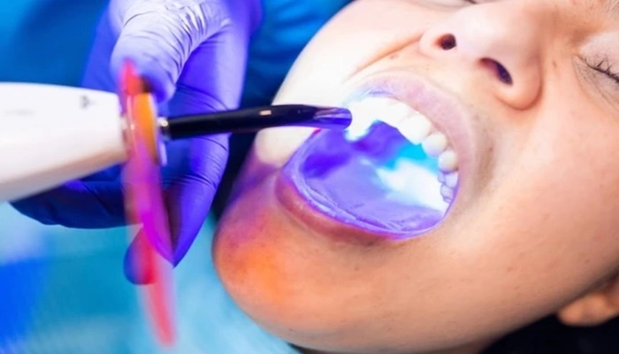 Restoration and Laser Filling at Apex Dental Care Bhadrak